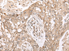 Immunohistochemistry of paraffin-embedded Human lung cancer tissue  using M1AP Polyclonal Antibody at dilution of 1:45(×200)