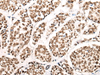 Immunohistochemistry of paraffin-embedded Human esophagus cancer tissue  using HGH1 Polyclonal Antibody at dilution of 1:45(×200)