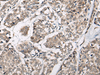 Immunohistochemistry of paraffin-embedded Human esophagus cancer tissue  using CACNB3 Polyclonal Antibody at dilution of 1:55(×200)