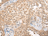Immunohistochemistry of paraffin-embedded Human ovarian cancer tissue  using CABIN1 Polyclonal Antibody at dilution of 1:50(×200)
