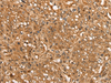 Immunohistochemistry of paraffin-embedded Human liver cancer tissue  using CALML6 Polyclonal Antibody at dilution of 1:55(×200)