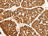 Immunohistochemistry of paraffin-embedded Human esophagus cancer tissue  using CALML6 Polyclonal Antibody at dilution of 1:55(×200)