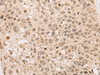 Immunohistochemistry of paraffin-embedded Human lung cancer tissue  using CAPN15 Polyclonal Antibody at dilution of 1:50(×200)