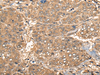 Immunohistochemistry of paraffin-embedded Human liver cancer tissue  using CCL27 Polyclonal Antibody at dilution of 1:55(×200)