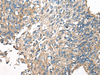 Immunohistochemistry of paraffin-embedded Human lung cancer tissue  using CDC42BPA Polyclonal Antibody at dilution of 1:60(×200)