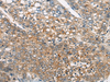 Immunohistochemistry of paraffin-embedded Human liver cancer tissue  using CDKL4 Polyclonal Antibody at dilution of 1:45(×200)