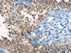 Immunohistochemistry of paraffin-embedded Human ovarian cancer tissue  using CDKL4 Polyclonal Antibody at dilution of 1:45(×200)