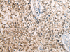 Immunohistochemistry of paraffin-embedded Human lung cancer tissue  using CDT1 Polyclonal Antibody at dilution of 1:45(×200)