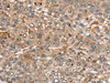 Immunohistochemistry of paraffin-embedded Human liver cancer tissue  using CDT1 Polyclonal Antibody at dilution of 1:45(×200)