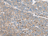 Immunohistochemistry of paraffin-embedded Human liver cancer tissue  using GULP1 Polyclonal Antibody at dilution of 1:65(×200)