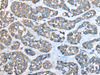 Immunohistochemistry of paraffin-embedded Human esophagus cancer tissue  using GULP1 Polyclonal Antibody at dilution of 1:65(×200)