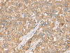 Immunohistochemistry of paraffin-embedded Human liver cancer tissue  using CHKA Polyclonal Antibody at dilution of 1:35(×200)