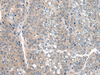 Immunohistochemistry of paraffin-embedded Human liver cancer tissue  using CLTCL1 Polyclonal Antibody at dilution of 1:60(×200)