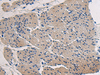 Immunohistochemistry of paraffin-embedded Human gastric cancer tissue  using COL17A1 Polyclonal Antibody at dilution of 1:50(×200)