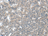 Immunohistochemistry of paraffin-embedded Human liver cancer tissue  using CARD16 Polyclonal Antibody at dilution of 1:55(×200)