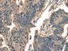 Immunohistochemistry of paraffin-embedded Human colorectal cancer tissue  using DNAJC2 Polyclonal Antibody at dilution of 1:40(×200)