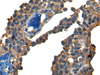 Immunohistochemistry of paraffin-embedded Human ovarian cancer tissue  using DNAJC2 Polyclonal Antibody at dilution of 1:40(×200)