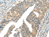 Immunohistochemistry of paraffin-embedded Human colorectal cancer tissue  using AIFM2 Polyclonal Antibody at dilution of 1:40(×200)