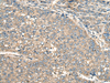 Immunohistochemistry of paraffin-embedded Human liver cancer tissue  using PIAS3 Polyclonal Antibody at dilution of 1:55(×200)