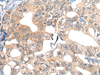 Immunohistochemistry of paraffin-embedded Human gastric cancer tissue  using EPHA6 Polyclonal Antibody at dilution of 1:40(×200)