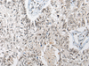 Immunohistochemistry of paraffin-embedded Human lung cancer tissue  using DGKI Polyclonal Antibody at dilution of 1:80(×200)