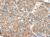 Immunohistochemistry of paraffin-embedded Human liver cancer tissue  using ACER1 Polyclonal Antibody at dilution of 1:50(×200)