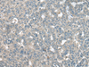 Immunohistochemistry of paraffin-embedded Human liver cancer tissue  using UCN3 Polyclonal Antibody at dilution of 1:55(×200)