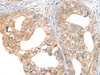 Immunohistochemistry of paraffin-embedded Human gastric cancer tissue  using CORO2A Polyclonal Antibody at dilution of 1:45(×200)