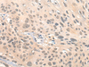 Immunohistochemistry of paraffin-embedded Human esophagus cancer tissue  using HIPK2 Polyclonal Antibody at dilution of 1:65(×200)
