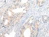 Immunohistochemistry of paraffin-embedded Human gastric cancer tissue  using NOG Polyclonal Antibody at dilution of 1:50(×200)