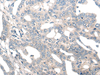 Immunohistochemistry of paraffin-embedded Human liver cancer tissue  using NOG Polyclonal Antibody at dilution of 1:50(×200)