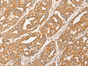 Immunohistochemistry of paraffin-embedded Human liver cancer tissue  using GNB1L Polyclonal Antibody at dilution of 1:35(×200)