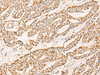 Immunohistochemistry of paraffin-embedded Human liver cancer tissue  using COX6C Polyclonal Antibody at dilution of 1:25(×200)