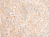 Immunohistochemistry of paraffin-embedded Human esophagus cancer tissue  using COX6C Polyclonal Antibody at dilution of 1:25(×200)