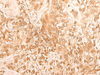 Immunohistochemistry of paraffin-embedded Human gastric cancer tissue  using DBP Polyclonal Antibody at dilution of 1:25(×200)
