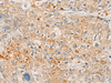 Immunohistochemistry of paraffin-embedded Human prost ate cancer tissue  using FBXO32 Polyclonal Antibody at dilution of 1:45(×200)