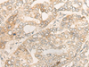 Immunohistochemistry of paraffin-embedded Human liver cancer tissue  using DUOX2 Polyclonal Antibody at dilution of 1:40(×200)