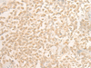 Immunohistochemistry of paraffin-embedded Human ovarian cancer tissue  using DUSP27 Polyclonal Antibody at dilution of 1:50(×200)