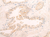Immunohistochemistry of paraffin-embedded Human prost ate cancer tissue  using ELANE Polyclonal Antibody at dilution of 1:25(×200)