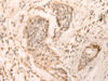 Immunohistochemistry of paraffin-embedded Human esophagus cancer tissue  using ELP4 Polyclonal Antibody at dilution of 1:25(×200)