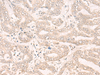 Immunohistochemistry of paraffin-embedded Human liver cancer tissue  using ENO4 Polyclonal Antibody at dilution of 1:30(×200)