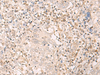 Immunohistochemistry of paraffin-embedded Human cervical cancer tissue  using EPSTI1 Polyclonal Antibody at dilution of 1:25(×200)