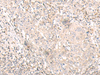 Immunohistochemistry of paraffin-embedded Human cervical cancer tissue  using IL24 Polyclonal Antibody at dilution of 1:30(×200)