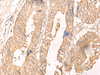 Immunohistochemistry of paraffin-embedded Human colorectal cancer tissue  using IL24 Polyclonal Antibody at dilution of 1:30(×200)