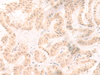 Immunohistochemistry of paraffin-embedded Human thyroid cancer tissue  using IL33 Polyclonal Antibody at dilution of 1:25(×200)