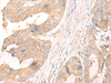 Immunohistochemistry of paraffin-embedded Human colorectal cancer tissue  using MYDGF Polyclonal Antibody at dilution of 1:25(×200)