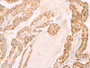 Immunohistochemistry of paraffin-embedded Human thyroid cancer tissue  using IL7R Polyclonal Antibody at dilution of 1:45(×200)