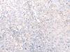 Immunohistochemistry of paraffin-embedded Human cervical cancer tissue  using HLA-C Polyclonal Antibody at dilution of 1:25(×200)