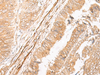 Immunohistochemistry of paraffin-embedded Human colorectal cancer tissue  using EPS15 Polyclonal Antibody at dilution of 1:50(×200)