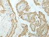 Immunohistochemistry of paraffin-embedded Human thyroid cancer tissue  using ETAA1 Polyclonal Antibody at dilution of 1:25(×200)